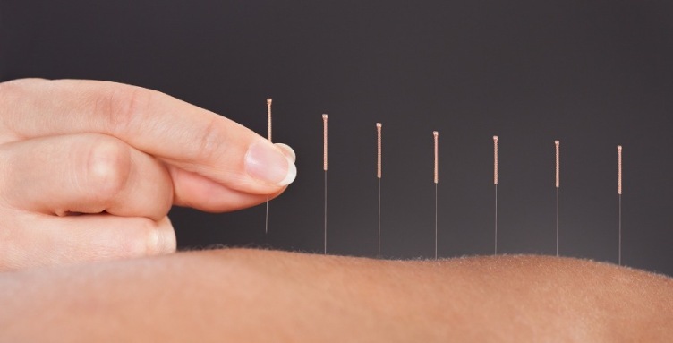 akupunkturun yararları