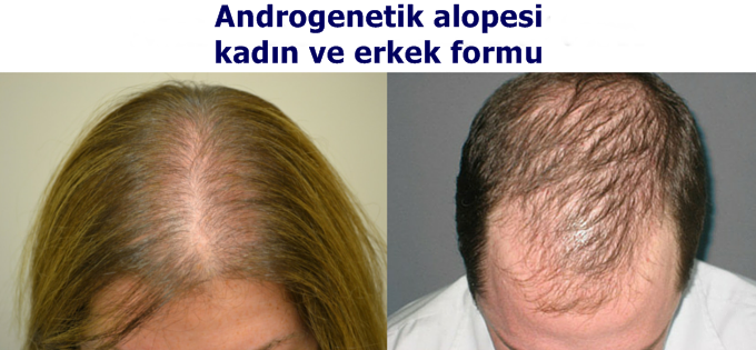 Androgenetik alopesi kadın ve erkek tipi saç dökülmesi