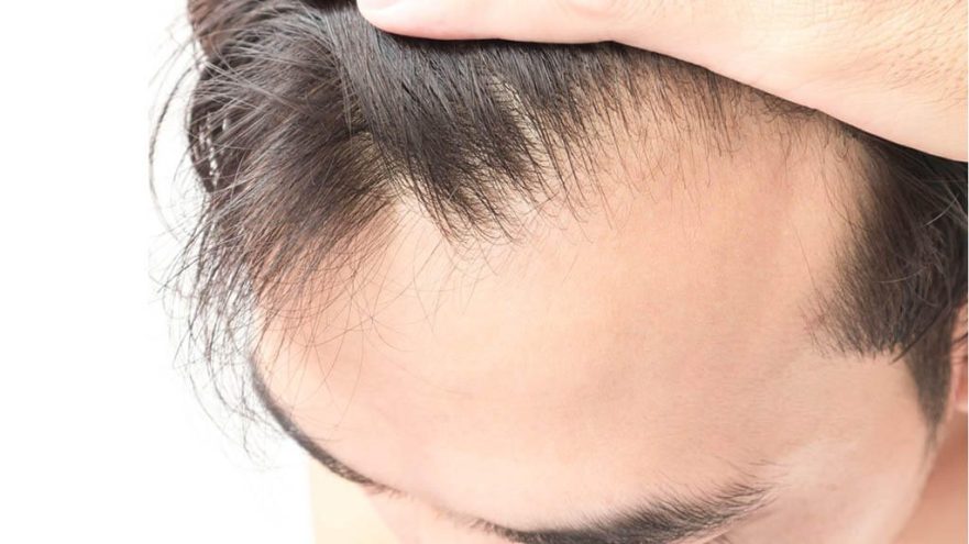 Telogen effluvium hastalığı ve saç dökülmesi