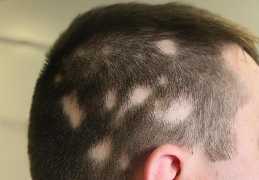 saçkıran - Alopecia areata -saç dökülmesi