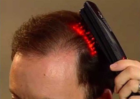 saç dökülmesini yavaşlatma için tedaviler - lazer tarak