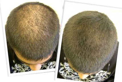 dermaroller saç kullanım öncesi ve sonrası dotoğrafı